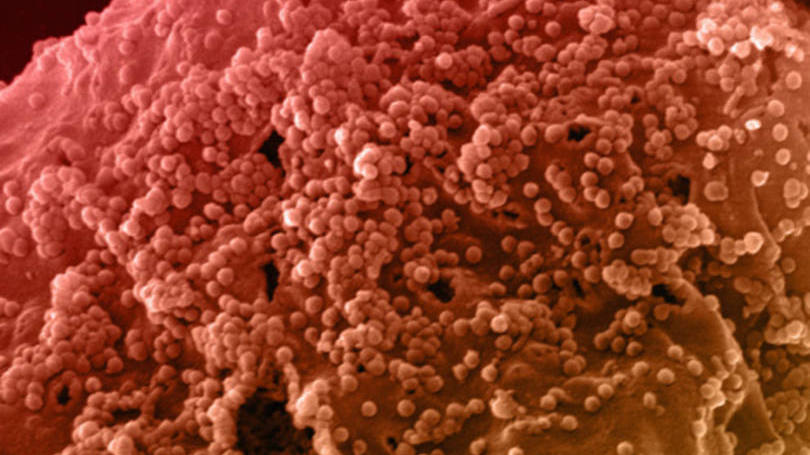 HIV: quando essas células humanas foram expostas ao vírus, estavam protegidas contra a reinfecção