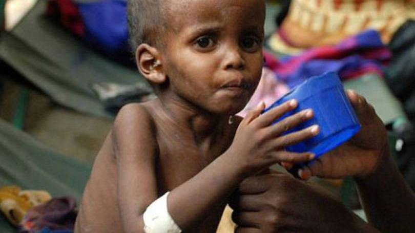 Fome na Somália: o coordenador humanitário da ONU destacou que mais de 300 mil crianças sofrem de desnutrição severa