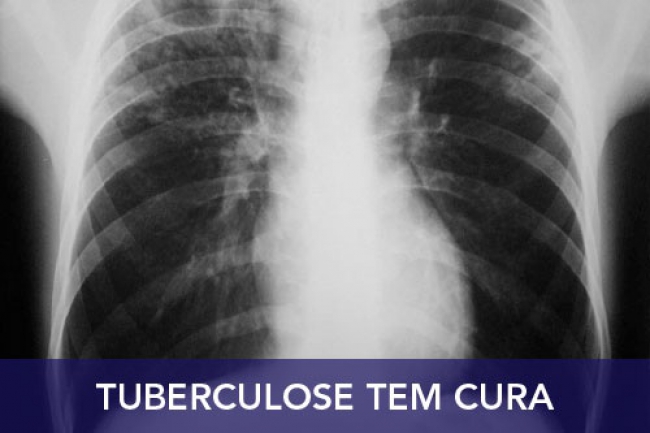 Sob o lema “” Unidos para acabar com a tuberculose”, celebra-se esta quinta-feira, o Dia Mundial de luta contra a Tuberculose.