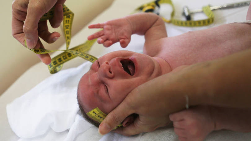 Microcefalia: dos 23 bebês estudados, 22 mostraram sinais de calcificação cerebral