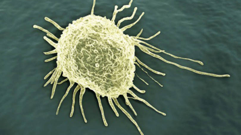 Representação de célula cancerígena: especialista ressalta que é um método pouco invasivo e evita a criação de inúmeras cicatrizes no abdome da mulher