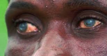 CERCA DE 1.500 PESSOAS ABRANGIDAS PELA CAMPANHA DE CIRURGIA DE CATARATAS